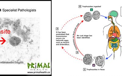 I Have a Parasite Called Dientamoeba Fragilis