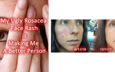 My Ugly Rosacea Face Rash is Making Me a Better Person