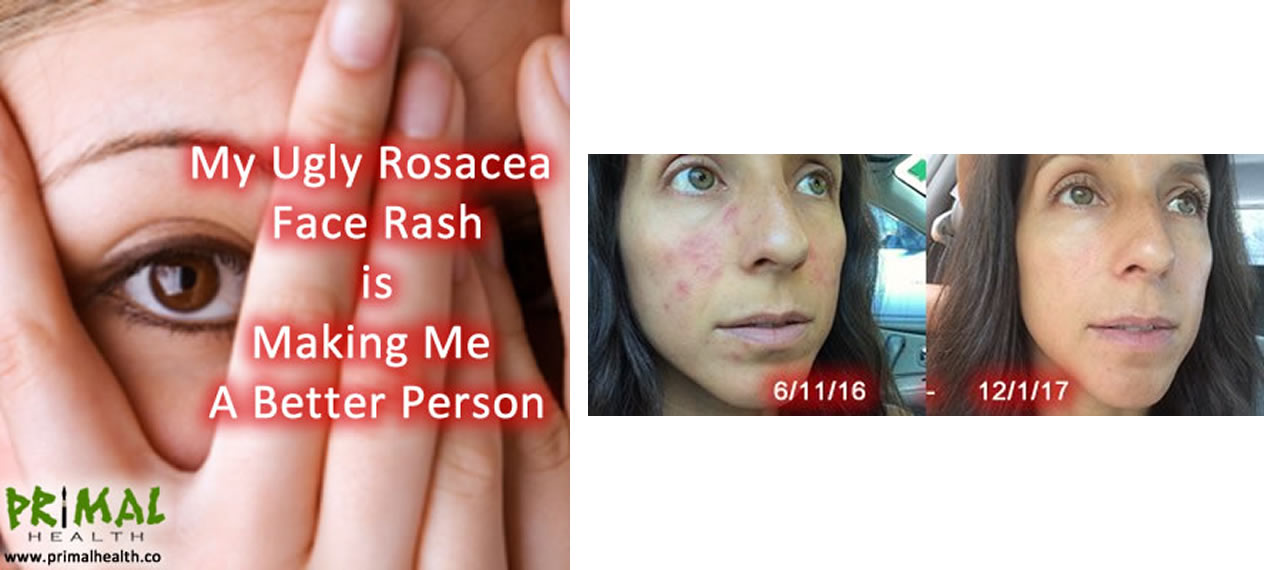 My Ugly Rosacea Face Rash is Making Me a Better Person