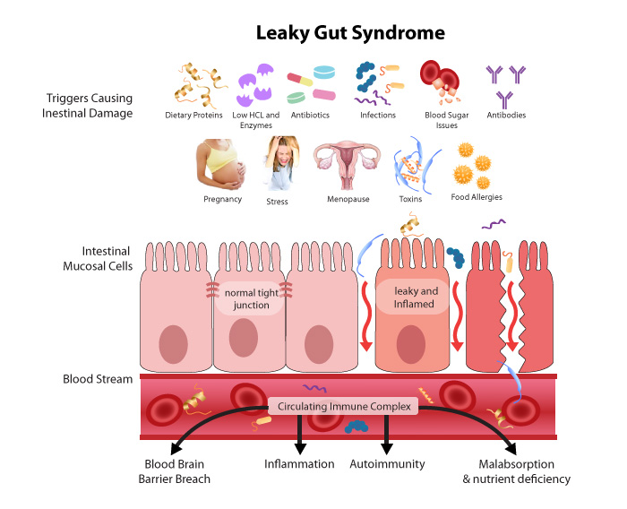 Leaky Gut Illustration from Delicious Obsessions.com