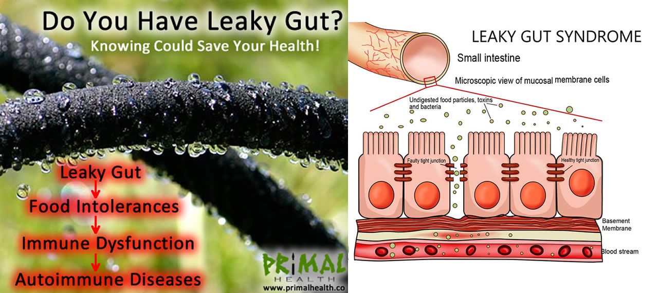 Do You Have a Leaky Gut? Knowing Could Save Your Health!