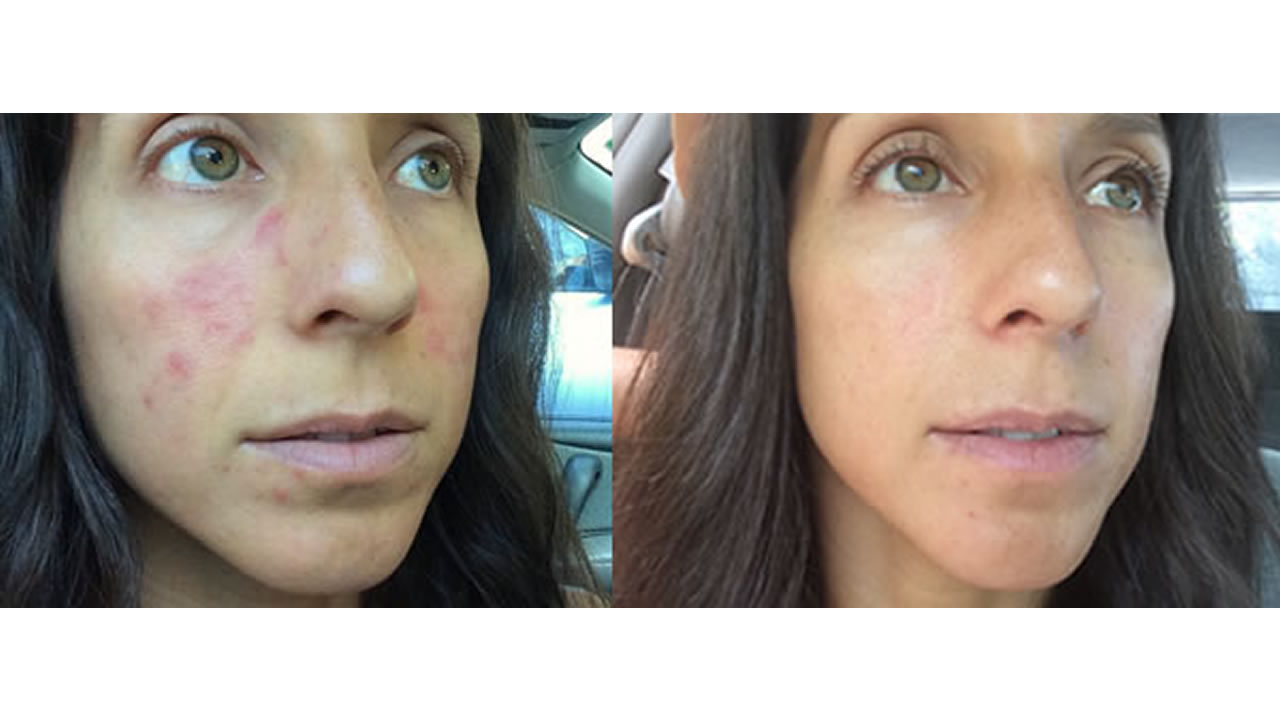 Rosacea Before and After - Bex